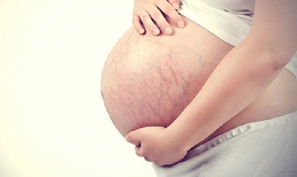 6 vấn đề về da thường gặp khi mang thai mẹ bầu cần chú ý