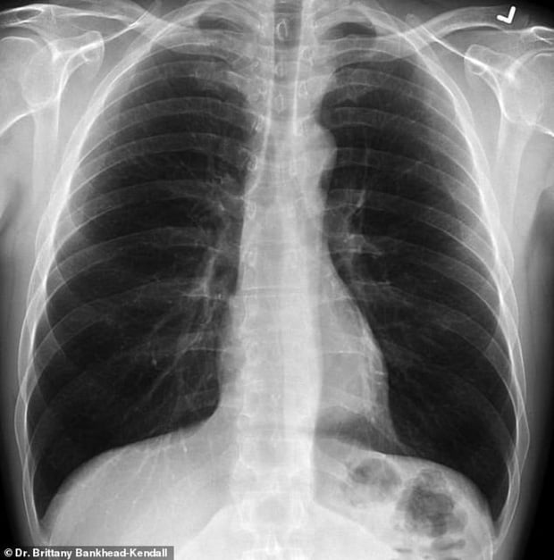 Shock of how devastating Covid-19 is to the human lung