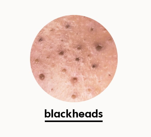 blackheads