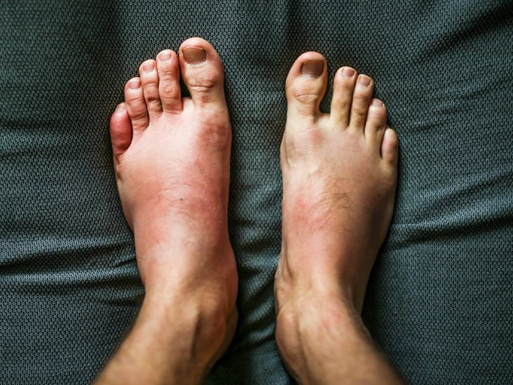 swollen toes. angioedema 732x549 thumbnail