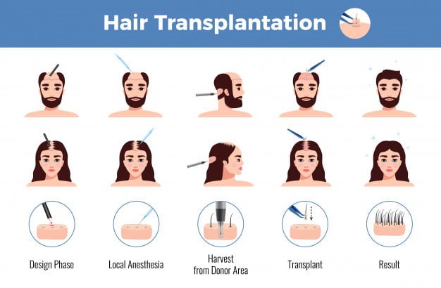 Hair transplantation men women - Photo by macrovector