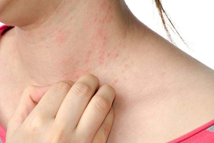 dust mite allergy rash symptoms treatment