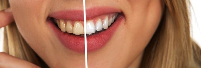 Pearly Whites: It’s Not Rocket Science