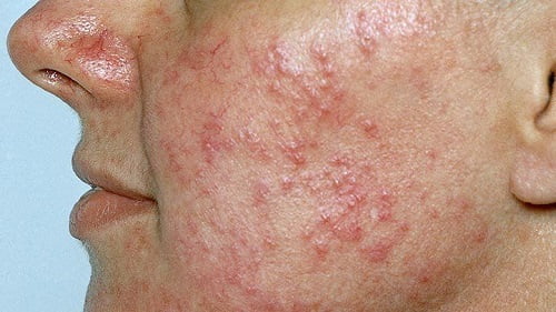 Papulopustular or acne rosacea
