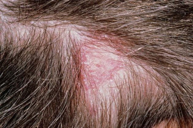 Natural Treatments To Get Rid Of Scalp Fungus - LAVYON