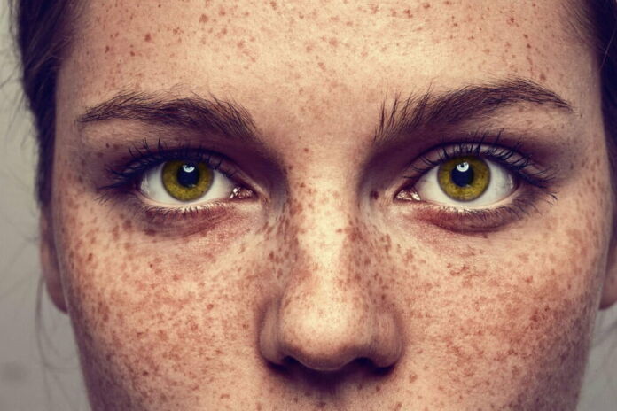 freckles