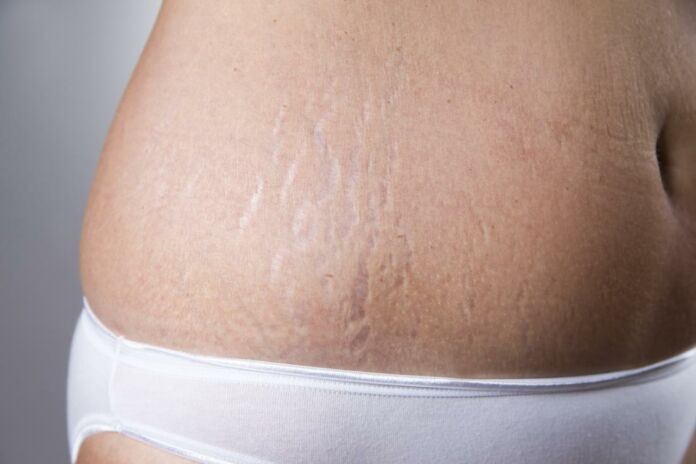 5 ways to fade stretch marks at home