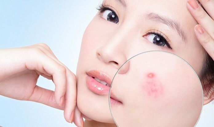 Bỏ túi các cách trị mụn hiệu quả tại nhà