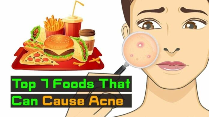 7 thực phẩm dễ gây nổi mụn chị em nên tránh