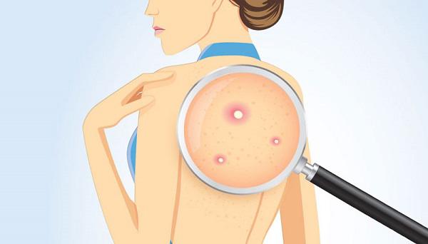 Tìm hiểu phương pháp trị mụn lưng hiệu quả ngay tại nhà