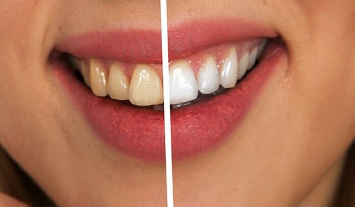 6 Causes of Yellow Teeth Stains