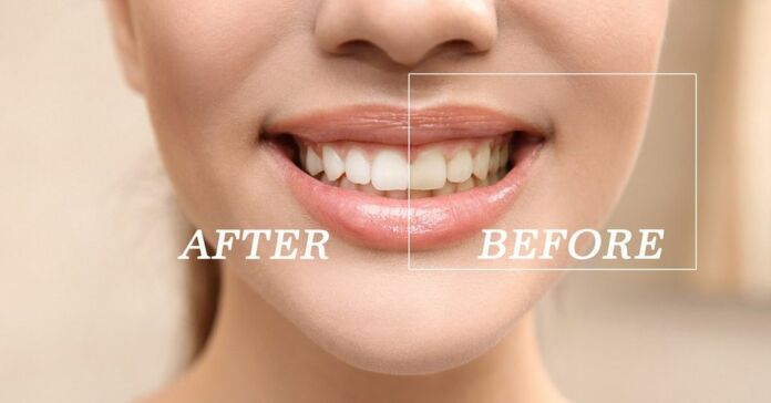 Teeth Discoloration
