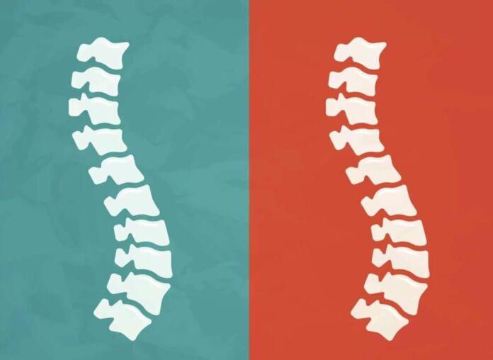 Ankylosing Spondylitis: 5 Facts About Biologicals - Filo/Getty Images