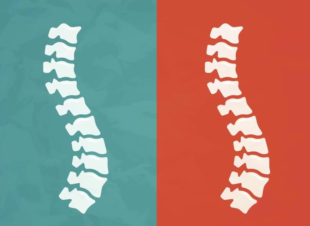 Ankylosing Spondylitis: 5 Facts About Biologicals - LAVYON