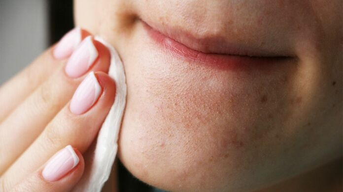 How to get rid of blackheads the right way? - Adobe Stock