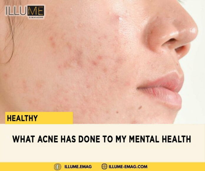 What Acne Has Done to My Mental Health