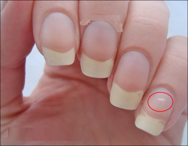 What Does A White Spot On Your Nails Mean