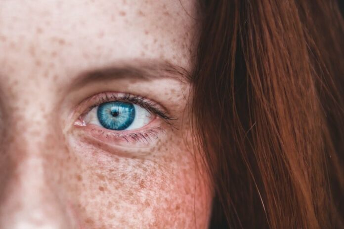 Eye Freckles Can Tell You A Lot About Your Well-Be - Photo by Erik Mclean