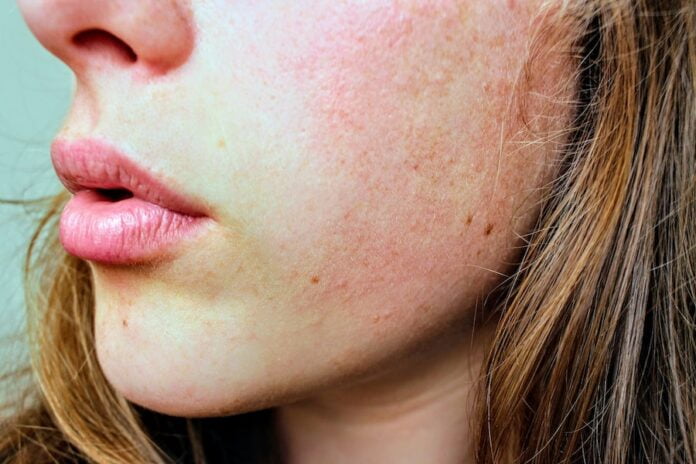 Oily Skin