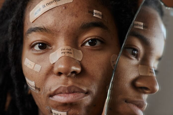 Hormonal Acne