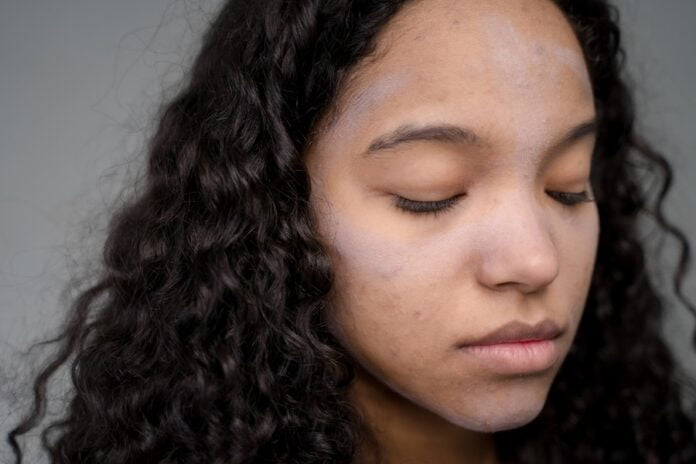 Milk and skin problems