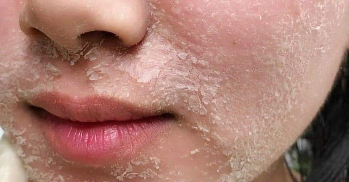 peel 